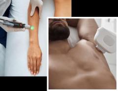 The best laser hair removal at Metamorphosis